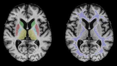 Multimodal Quantitative MRI Reveals No Evidence for Tissue Pathology in Idiopathic Cervical Dystonia